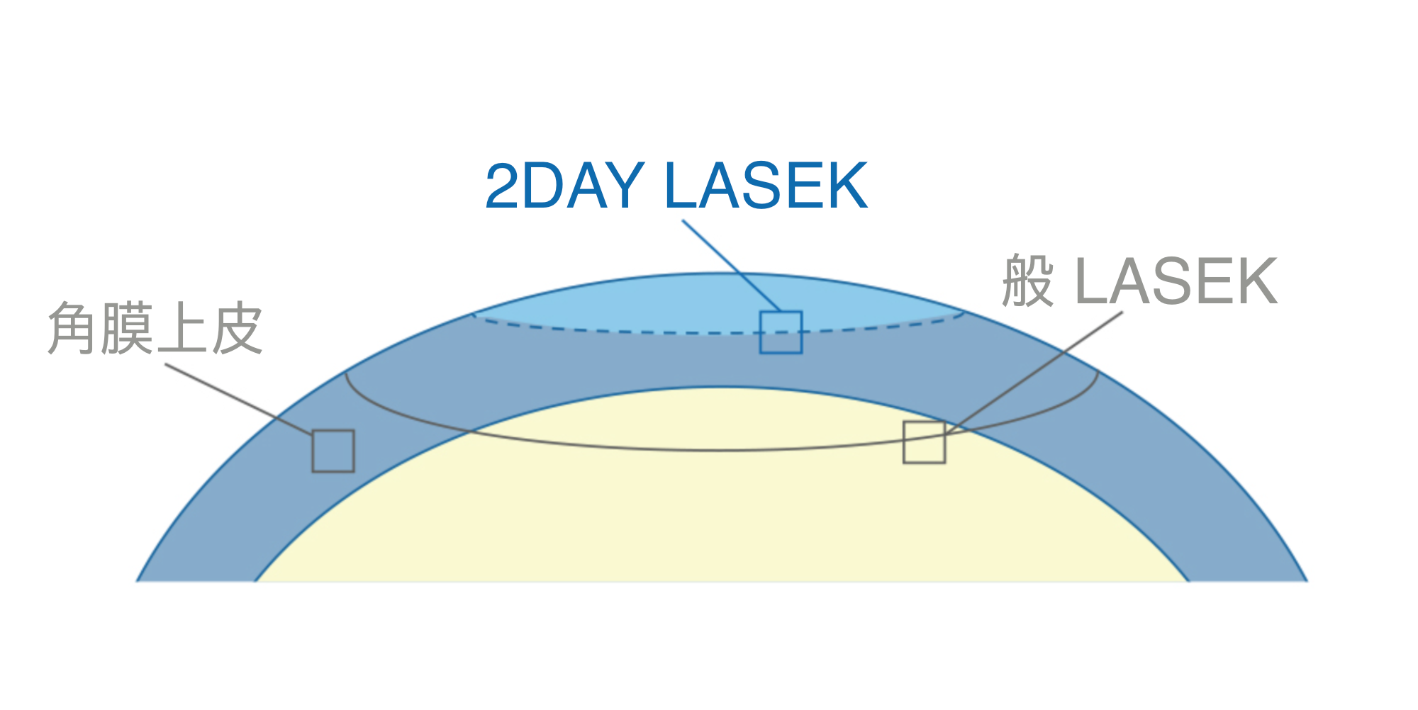 2DAY LASEK 手術說明圖片